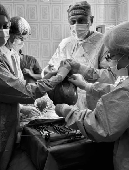 Рекордна операція у Львові: видалено 18,5 кг кістоми яєчника